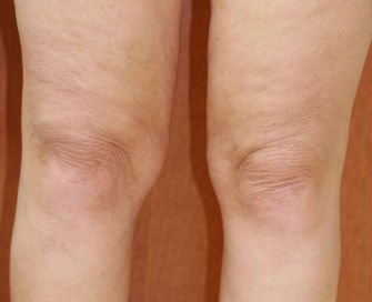 Liposuction Case 7 - before - front