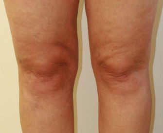 Liposuction Case 7 - after - front