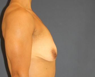 Weight Loss Breast Lift - before - side