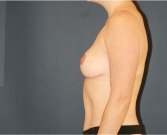 Breast Lift for Symmetry - after - side