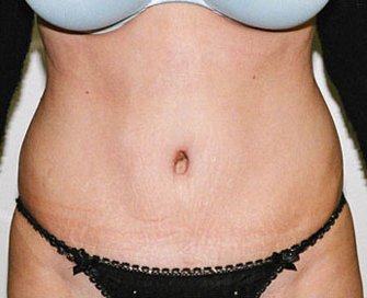 Tummy Tuck Case 11 - after - front