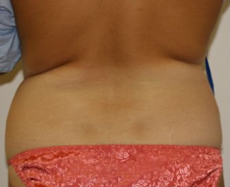 Liposuction of Waist and Flanks - before - front