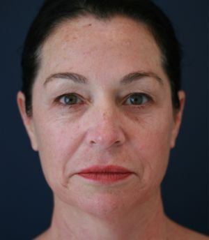 Three Months After - before - front