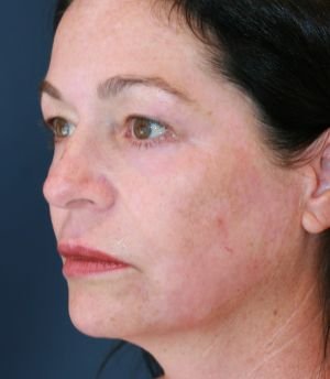Three Months After - after - left oblique