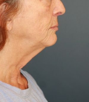 Sagging Neck Lift - before - right side