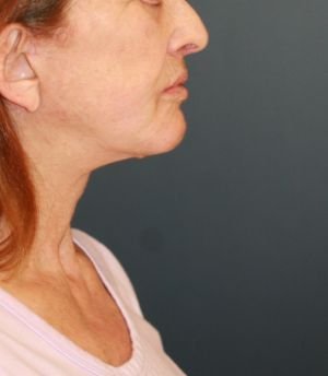 Sagging Neck Lift - after - right side