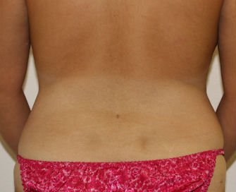 Liposuction of Waist and Flanks - after - front