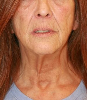 Sagging Neck Lift - before - left side