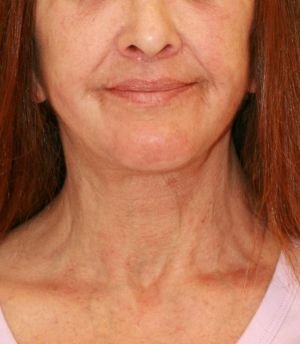 Sagging Neck Lift - after - left side