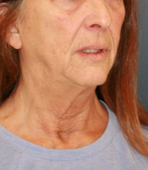 Sagging Neck Lift - before - oblique
