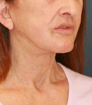 Sagging Neck Lift - after - oblique