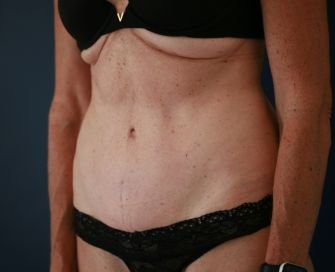 Type 2 Tummy Tuck - after - oblique