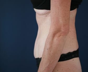 Type 2 Tummy Tuck - after - side