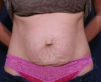 Tummy Tuck Times Two - before - front