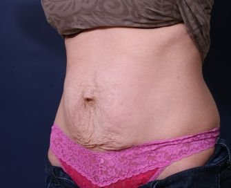 Tummy Tuck Times Two - before - left oblique