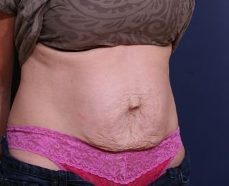 Tummy Tuck Times Two - before - right oblique