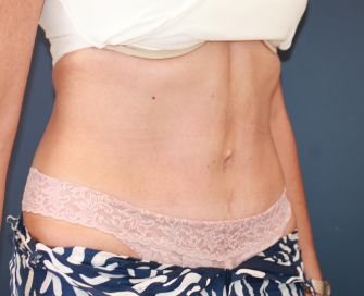 Tummy Tuck Times Two - after - right oblique