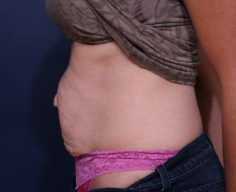 Tummy Tuck Times Two - before - side