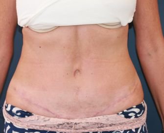 Tummy Tuck Scar - after - front
