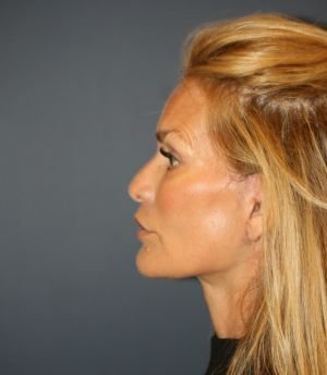 Preventive Face and Neck Lift - after - side