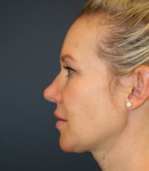Nose Surgery 228 - after - front