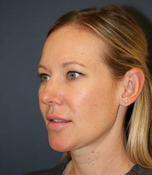 Nose Surgery 228 - before - oblique