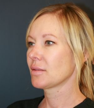 Nose Surgery 228 - after - oblique