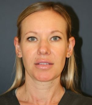 Nose Surgery 228 - before - side