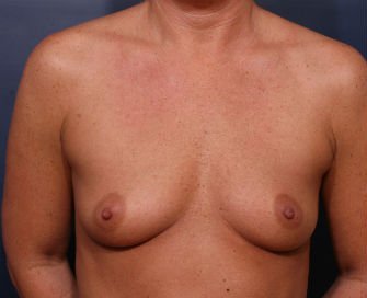 Breast Augmentation Case 45 - before - front