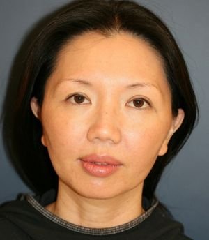 Nose, Eyes, and Chin Adjustments - before - front