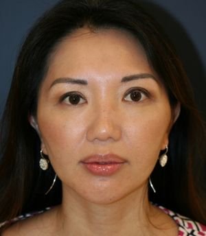 Nose, Eyes, and Chin Adjustments - after - front