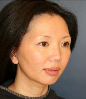 Nose, Eyes, and Chin Adjustments - before - oblique