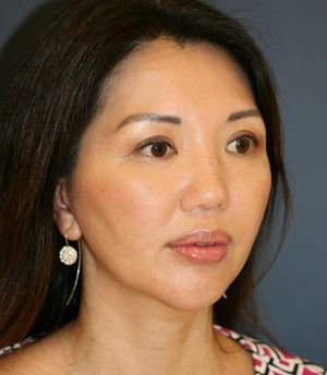 Nose, Eyes, and Chin Adjustments - after - oblique
