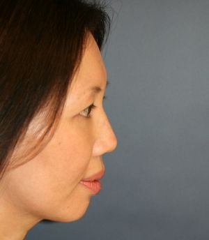 Nose, Eyes, and Chin Adjustments - before - side