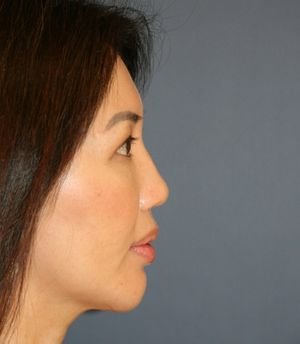 Nose, Eyes, and Chin Adjustments - after - side