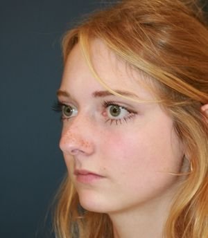 Rhinoplasty California - before - oblique