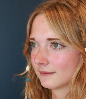 Rhinoplasty California - after - oblique