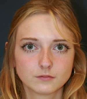 Rhinoplasty California - before - side
