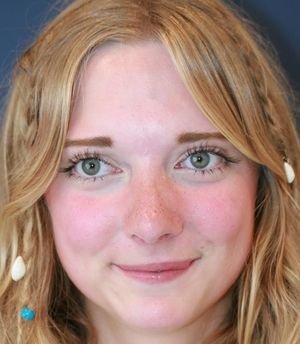 Rhinoplasty California - after - side
