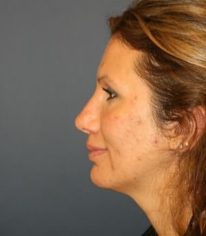Rhinoplasty Revision - before - front