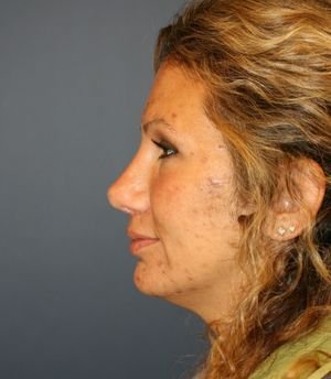 Rhinoplasty Revision - after - front