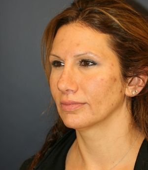 Rhinoplasty Revision - before - oblique