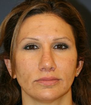 Rhinoplasty Revision - before - side