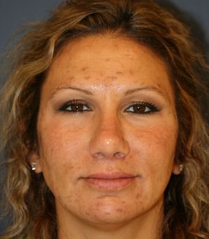 Rhinoplasty Revision - after - side