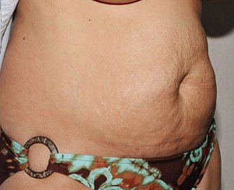 Tummy Tuck Case 11 - before - angle