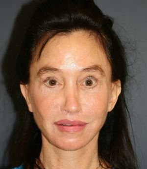 Hairline Lowering - before - front