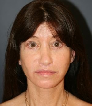 Hairline Lowering - after - front