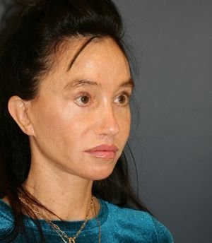 Hairline Lowering - before - left oblique