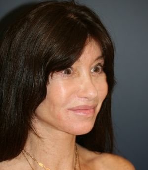 Hairline Lowering - after - left oblique