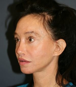 Hairline Lowering - before - right oblique